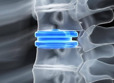 How Advanced Motion Analysis Technology Assesses Spinal Disc Replacement Outcomes