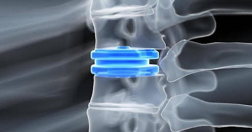 How Advanced Motion Analysis Technology Assesses Spinal Disc Replacement Outcomes