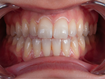 Does Misalignment Cause Tooth Decay?