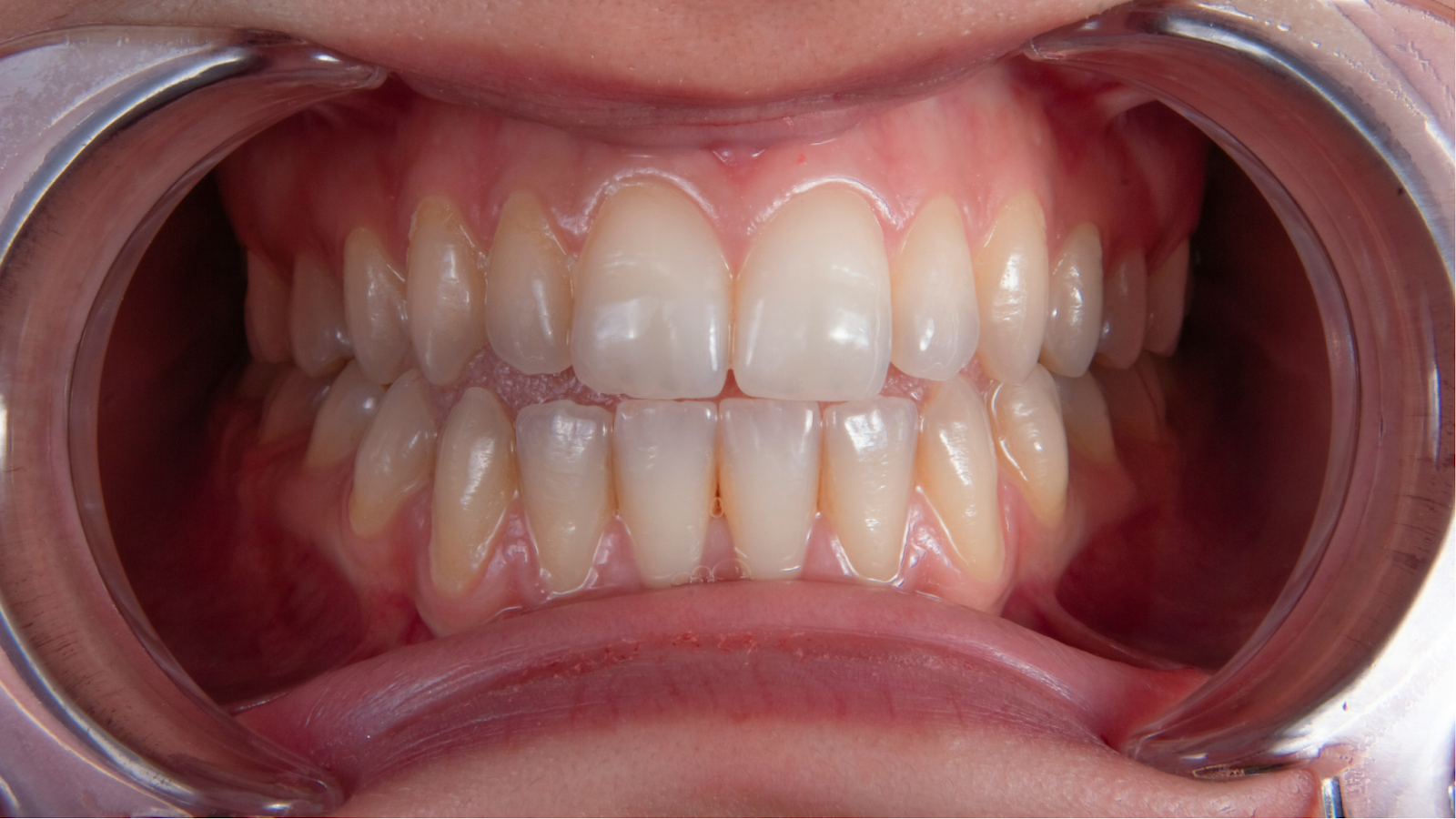 Does Misalignment Cause Tooth Decay?
