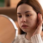 How To Treat Hyperpigmentation: A Complete Skincare Guide