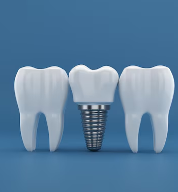 What Do Complete Dental Implants Involve in Coventry?