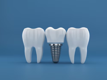 What Do Complete Dental Implants Involve in Coventry?