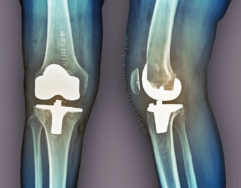When Is TKR Surgery the Right Option for Knee Pain?