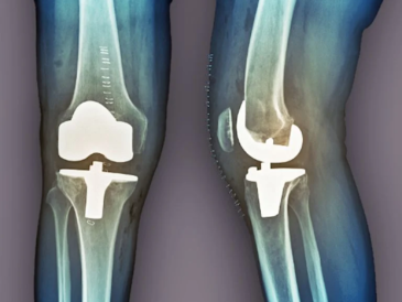 When Is TKR Surgery the Right Option for Knee Pain?