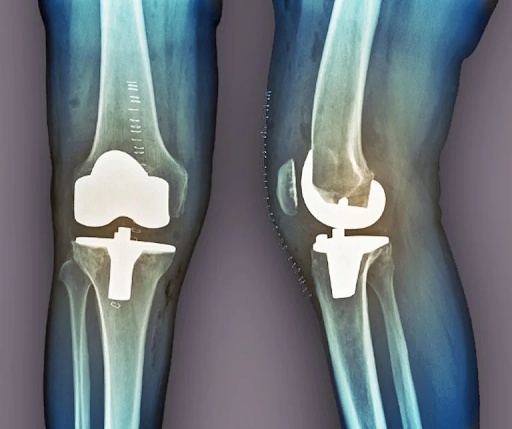 When Is TKR Surgery the Right Option for Knee Pain?